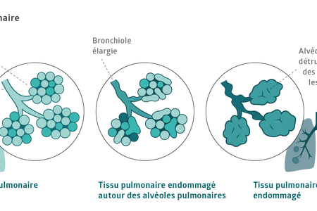 Fibrose pulmonaire : lorsque la respiration donne le tempo | Ligue  pulmonaire suisse,Ligue pulmonaire Thurgovie-Schaffhouse