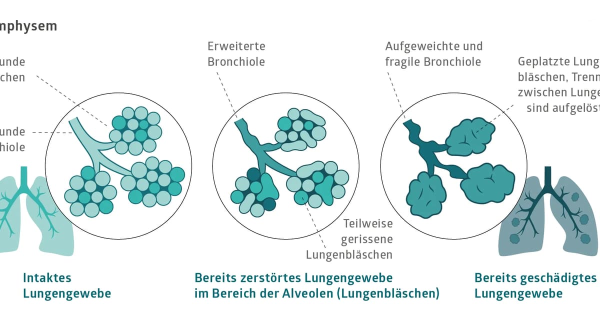 die-lunge-und-der-atem-vertiefen-sie-ihr-wissen-lungenliga-schweiz